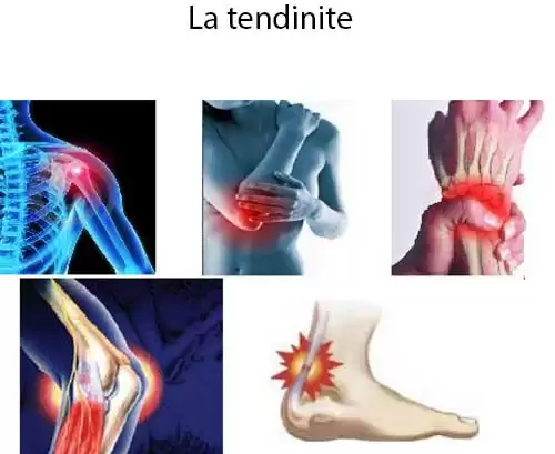tendinites 